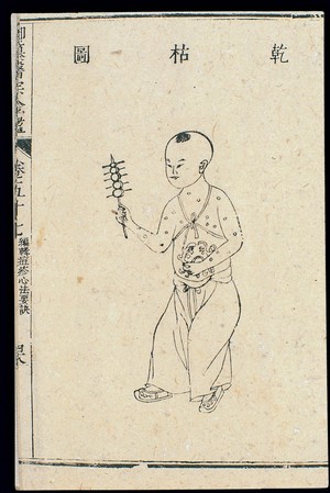 view Chinese C18: Paediatric pox - 'Dry and Wizened' pox