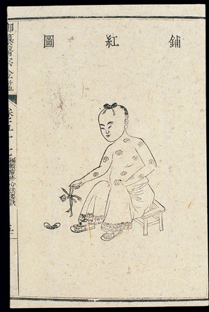 view Chinese C18: Paediatric pox - 'Red Covering' pox