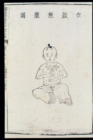 view Chinese C18: Paediatric pox - 'Empty shell without pulp'