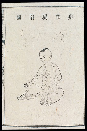 Chinese C18: Paediatric pox - 'Caved-in pock boils