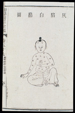 view Chinese C18: Paediatric pox - 'Grey and white indentations'