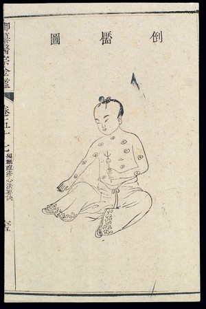 view Chinese C18: Paediatric pox - 'Inverted Dimple' pox