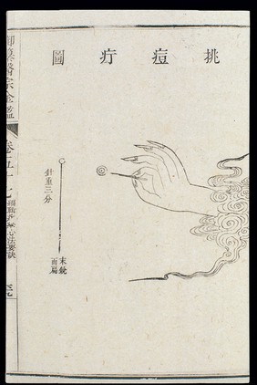 Chinese C18: Paediatric pox - 'Broken Bridge' pox