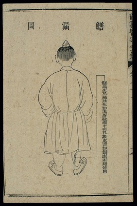 Chinese C18 woodcut: External medicine - 'Eel leak'