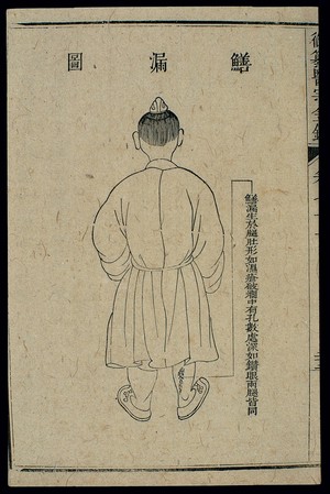 view Chinese C18 woodcut: External medicine - 'Eel leak'