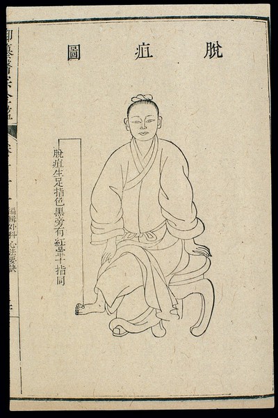 Chinese C18 woodcut: External medicine - Gangrene