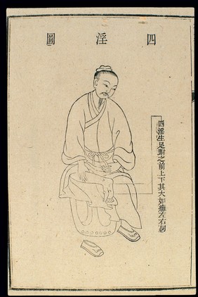 Chinese C18 woodcut: External medicine - Siyin ulcer