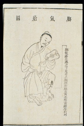 Chinese C18 woodcut: External medicine - Athlete's foot