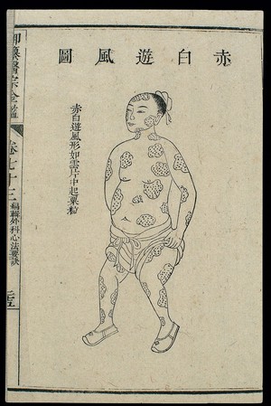 view Chinese C18 woodcut: External medicine - Dermatitis