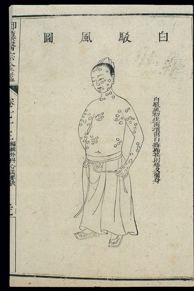 Chinese C18 woodcut: External medicine - 'White patch' rash