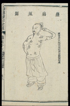 view Chinese C18 woodcut: External medicine - 'Scrofulous ulcers'