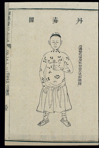 Chinese C18 woodcut: External medicine - Erysipelas