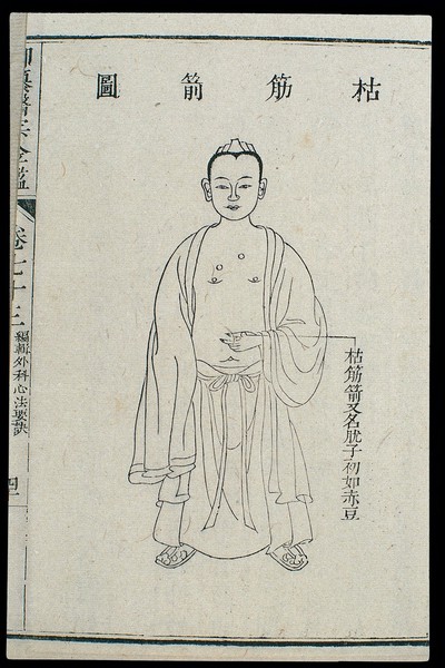 Chinese C18 woodcut: External medicine - Wart/verucca