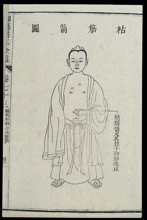 view Chinese C18 woodcut: External medicine - Wart/verucca