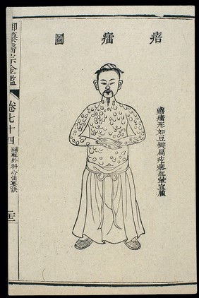 Chinese C18 woodcut: External medicine - Miliaria (peilei)