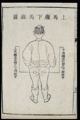 Chinese C18 woodcut: External medicine -- abscess on buttock