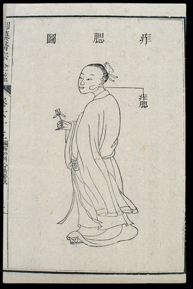 Chinese C18 woodcut: External medicine - Mumps