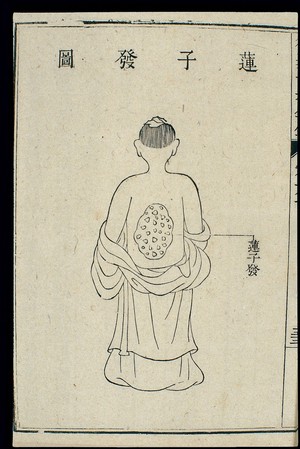 view Chinese C18 woodcut: External medicine - Lotus-seed' lesions