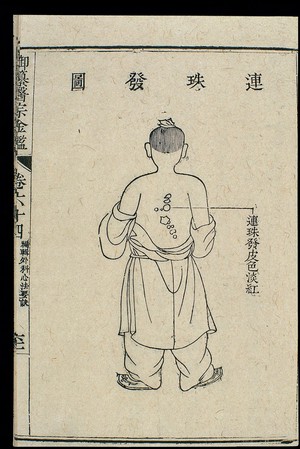 view Chinese C18 woodcut: External medicine - 'String of pearls'