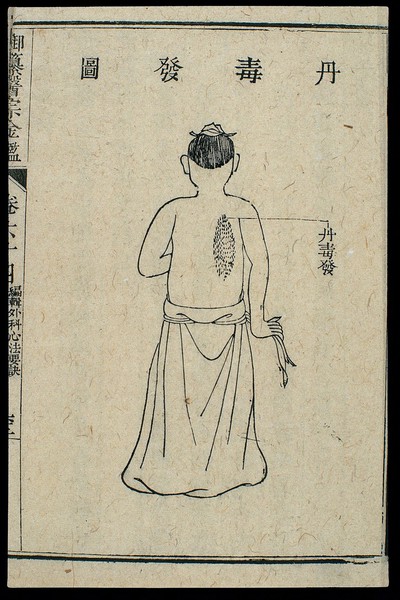 Chinese C18 woodcut: External medicine - Erysipelas