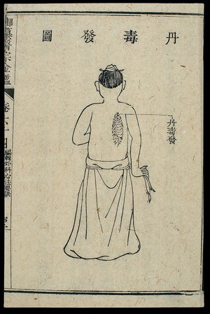 view Chinese C18 woodcut: External medicine - Erysipelas