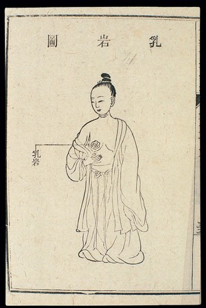 view Chinese C18 woodcut: The chest/breasts - Breast tumour