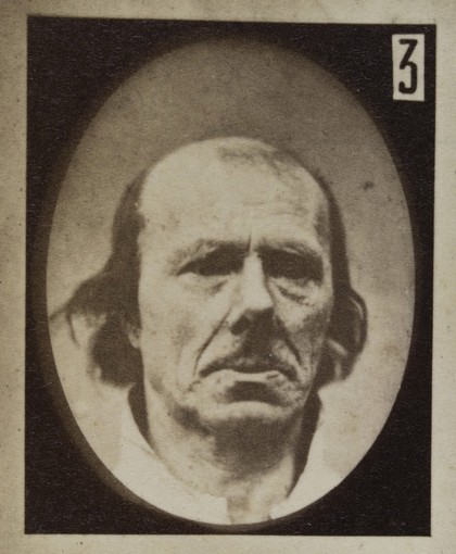 Mécanisme de la physionomie humaine, ou, Analyse électro-physiologique de l'expression des passions / [Guillaume Benjamin Amand Duchenne].