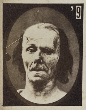 Mécanisme de la physionomie humaine, ou, Analyse électro-physiologique de l'expression des passions / [Guillaume Benjamin Amand Duchenne].