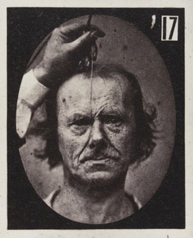 Mécanisme de la physionomie humaine, ou, Analyse électro-physiologique de l'expression des passions / [Guillaume Benjamin Amand Duchenne].