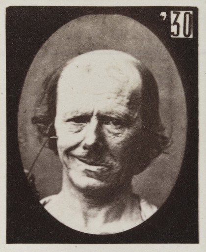 Mécanisme de la physionomie humaine, ou, Analyse électro-physiologique de l'expression des passions / [Guillaume Benjamin Amand Duchenne].