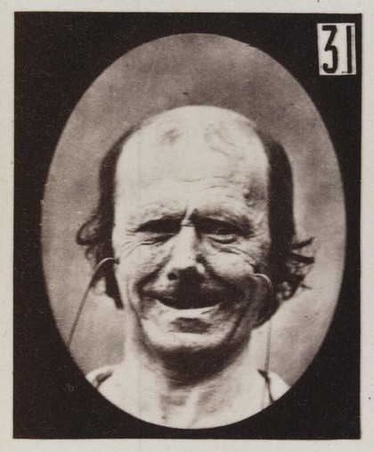 Mécanisme de la physionomie humaine, ou, Analyse électro-physiologique de l'expression des passions / [Guillaume Benjamin Amand Duchenne].