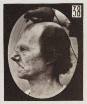 Mécanisme de la physionomie humaine, ou, Analyse électro-physiologique de l'expression des passions / [Guillaume Benjamin Amand Duchenne].