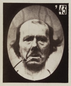 Mécanisme de la physionomie humaine, ou, Analyse électro-physiologique de l'expression des passions / [Guillaume Benjamin Amand Duchenne].