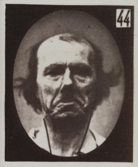 Mécanisme de la physionomie humaine, ou, Analyse électro-physiologique de l'expression des passions / [Guillaume Benjamin Amand Duchenne].