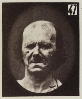 Mécanisme de la physionomie humaine, ou, Analyse électro-physiologique de l'expression des passions / [Guillaume Benjamin Amand Duchenne].