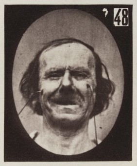 Mécanisme de la physionomie humaine, ou, Analyse électro-physiologique de l'expression des passions / [Guillaume Benjamin Amand Duchenne].