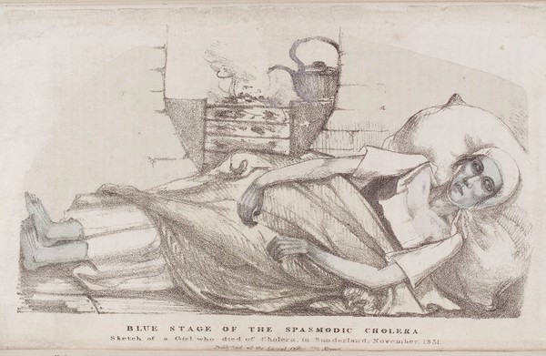 Blue stage of the spasmodic Cholera of a girls who dies in Sunderland, November 1831