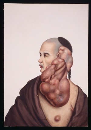 view A man (Wan Wakae) with massive pendent tumours on the left side of his face. Gouache, 18--, after Lam Qua, ca. 1838.