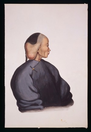 view A woman with a pendent tumour over her right ear. Gouache, 18--, after Lam Qua, ca. 183-.