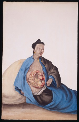 view A woman with a tumour in her right breast which is expanding over her trunk. Gouache, 18--, after Lam Qua, ca. 183-.