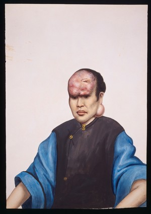 view A woman (Le Sanying) with tumours on her forehead and under her left ear. Gouache, 18--, after Lam Qua, ca. 1838.