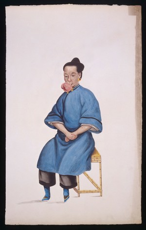 view A woman (Kwo Pe) with a tumour hanging from her upper lip. Gouache, 18--, after Lam Qua, ca. 1839.