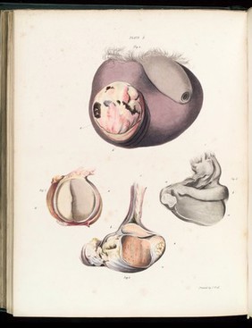 Inflammation of the testis