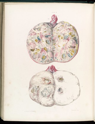 Hydatid testis after removal from a living body