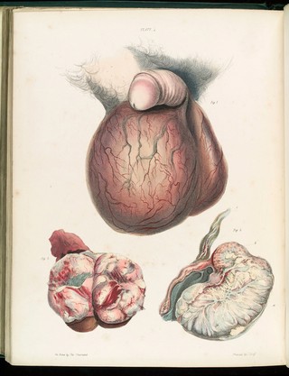 Fungoid disease of the testis
