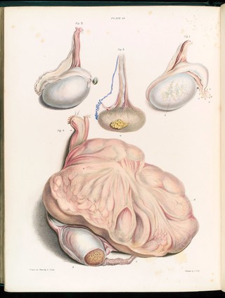 Testis with tumours