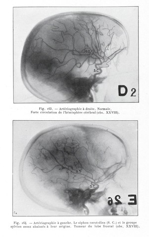 view Arteriographie a droite, a gauche