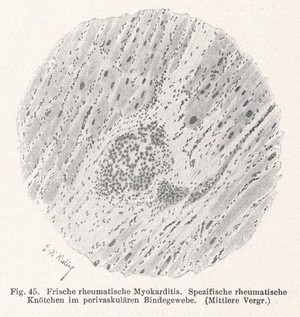 view Frische rheumatische Myokarditis. Spezifische rheumatische knotchen im perivaskularen bindegewebe. (Mittlere Vergr).