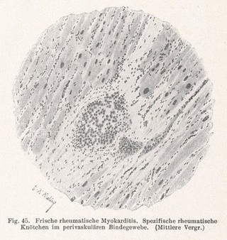 Frische rheumatische Myokarditis. Spezifische rheumatische knotchen im perivaskularen bindegewebe. (Mittlere Vergr).