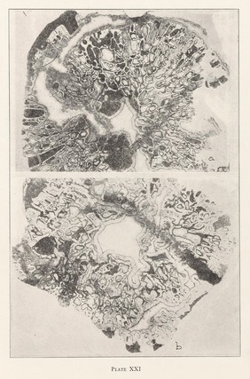 A permian osteomyelitis from Moodie's Paleopathology